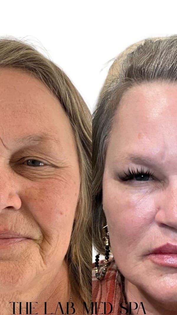 Post 9 by Shelby G.  BSN, RN, CANS BISHOP ARTS| DALLAS|SOUTHLAKE INJECTOR on Instagram (video)