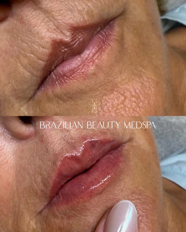 Post 10 by BELA SASDELLI - VB NURSE INJECTOR on Instagram (video)
