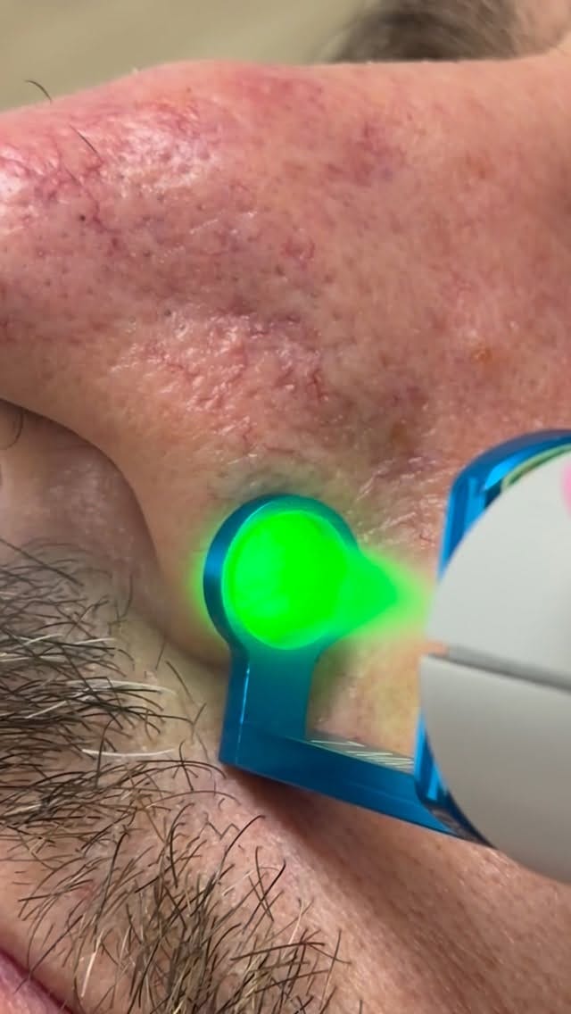 Post 6 by Catherine DiGiorgio,MD,MS,FAAD on Instagram (video)
