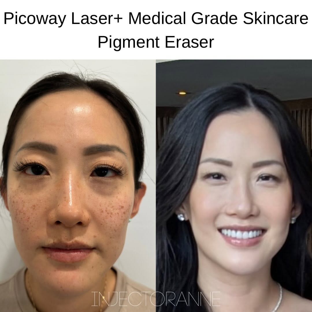 Post 8 by ANNE CHIANG, MSN, NP-C | DMV NURSE INJECTOR 💉 on Instagram (carousel)