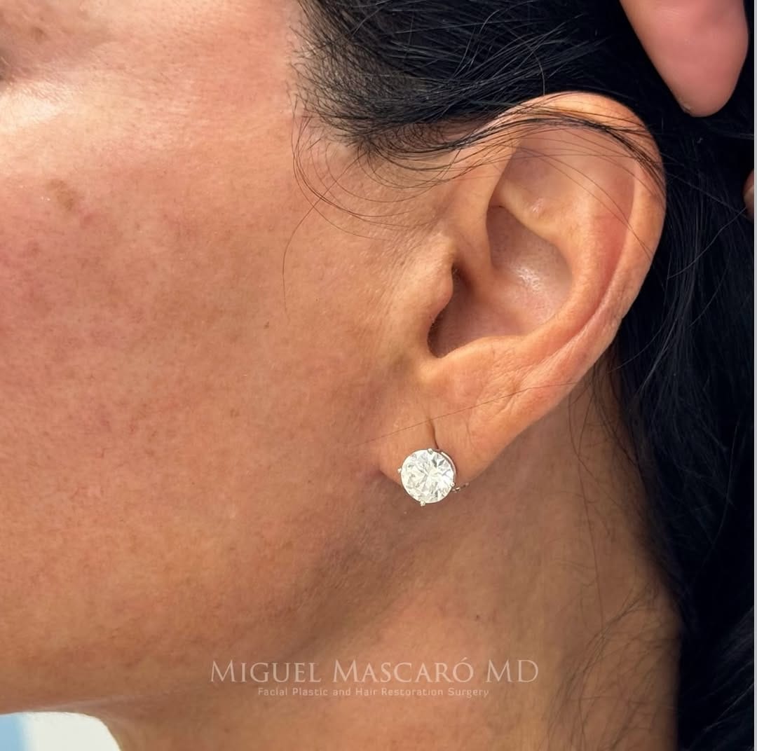 Post 3 by 5th Avenue Plastic Surgery on Instagram (carousel)