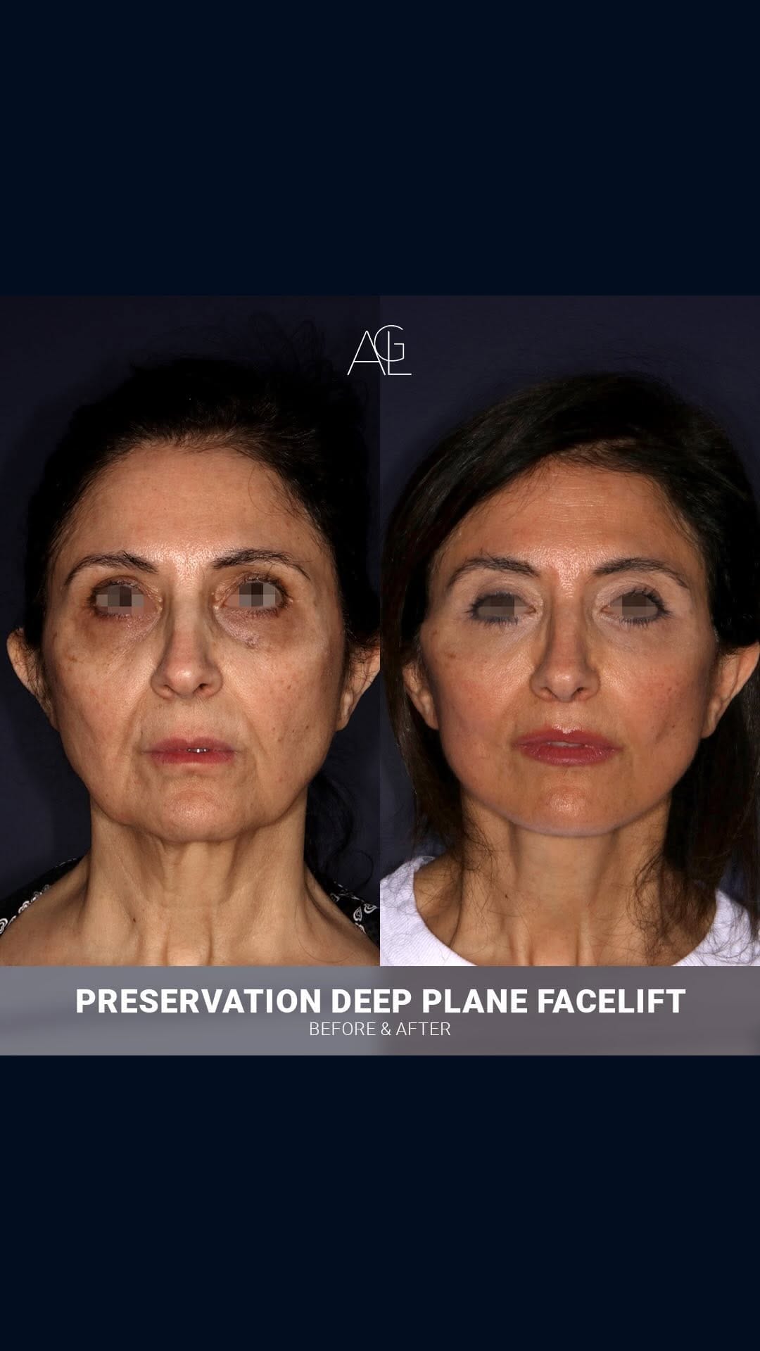 Post 10 by Dr A. Lellouch | Plastic Surgeon on Instagram (video)
