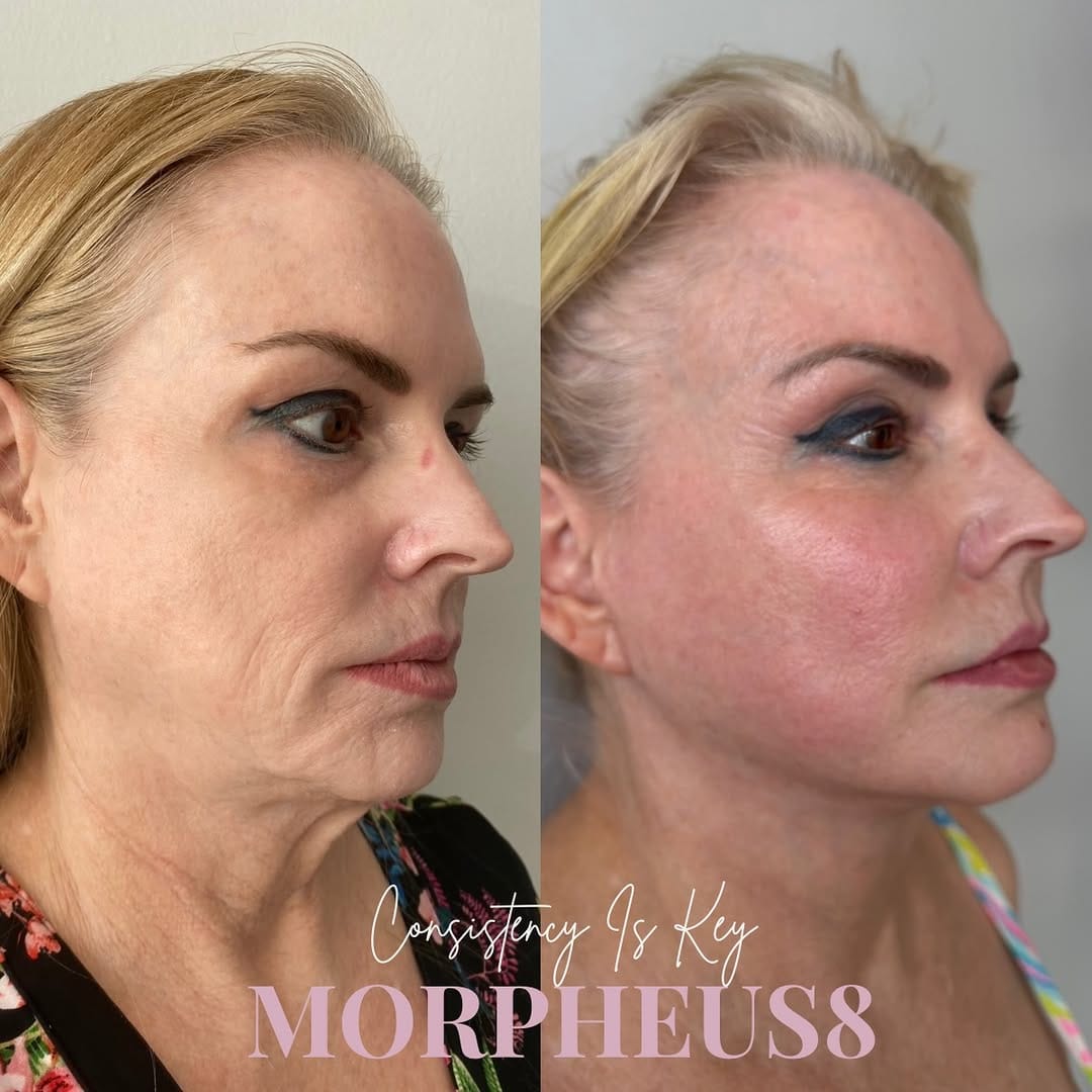 Post 4 by Kumi | Houston’s Best Laser & Medspa on Instagram (carousel)