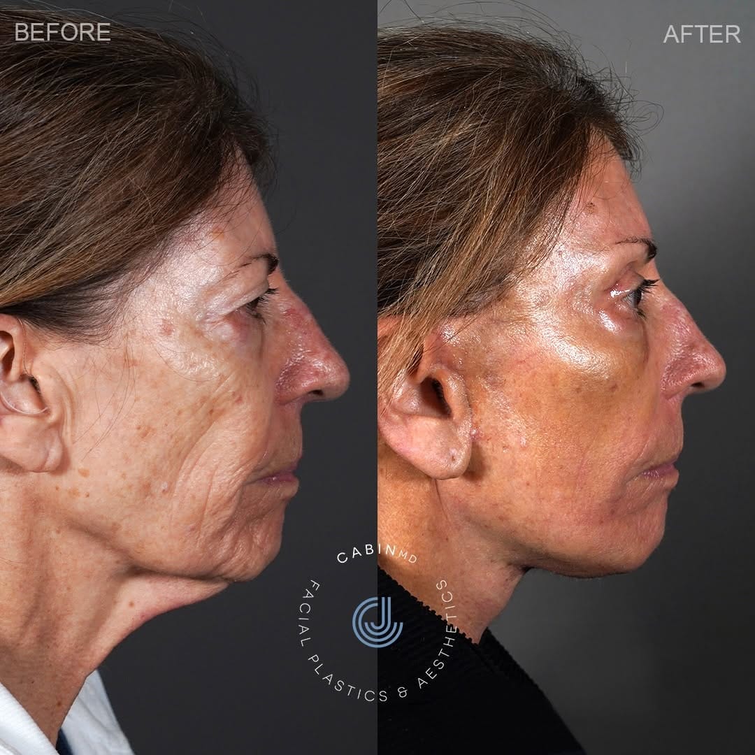 Post 8 by Jon Cabin - DC Plastic Surgeon on Instagram (carousel)