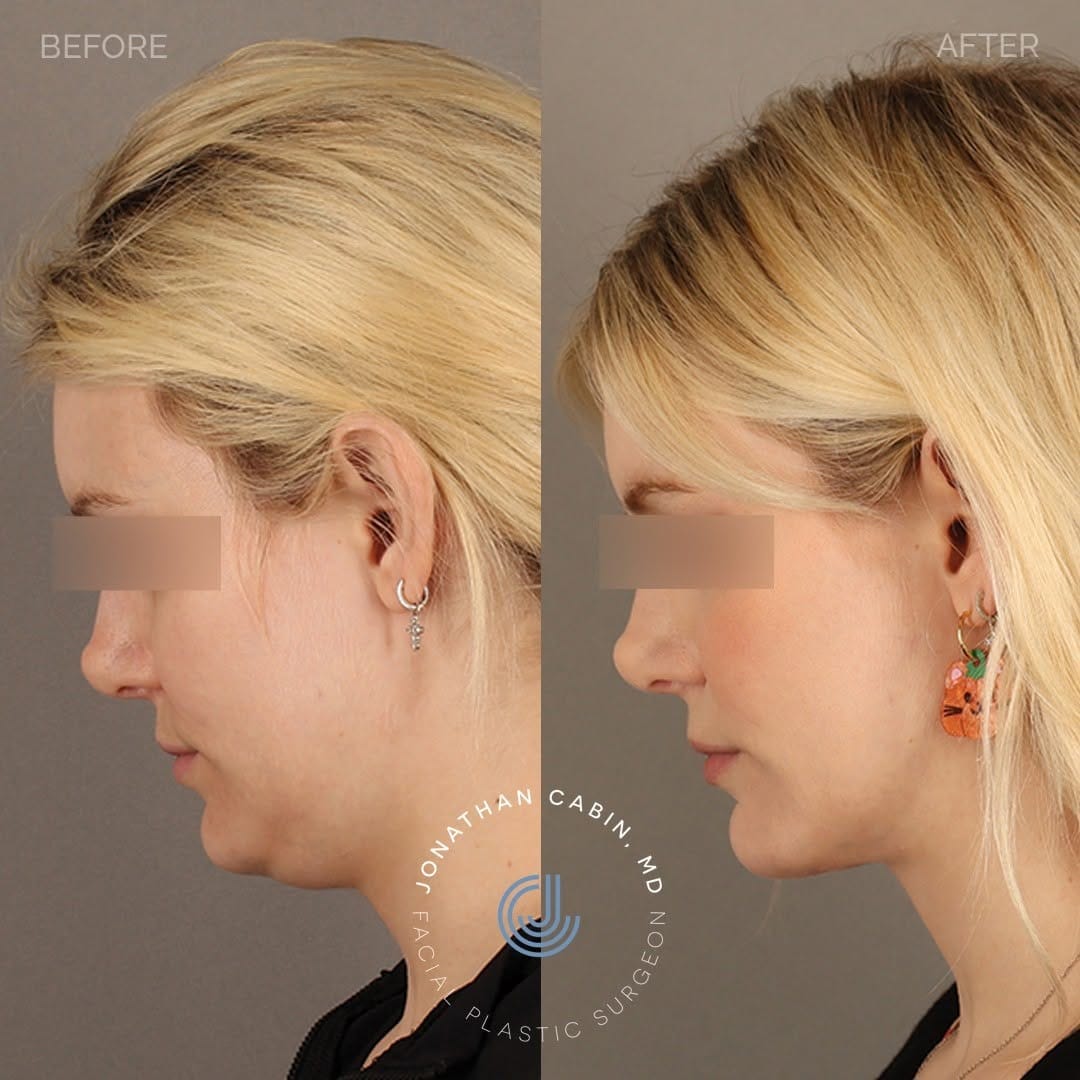 Post 9 by Jon Cabin - DC Plastic Surgeon on Instagram (carousel)