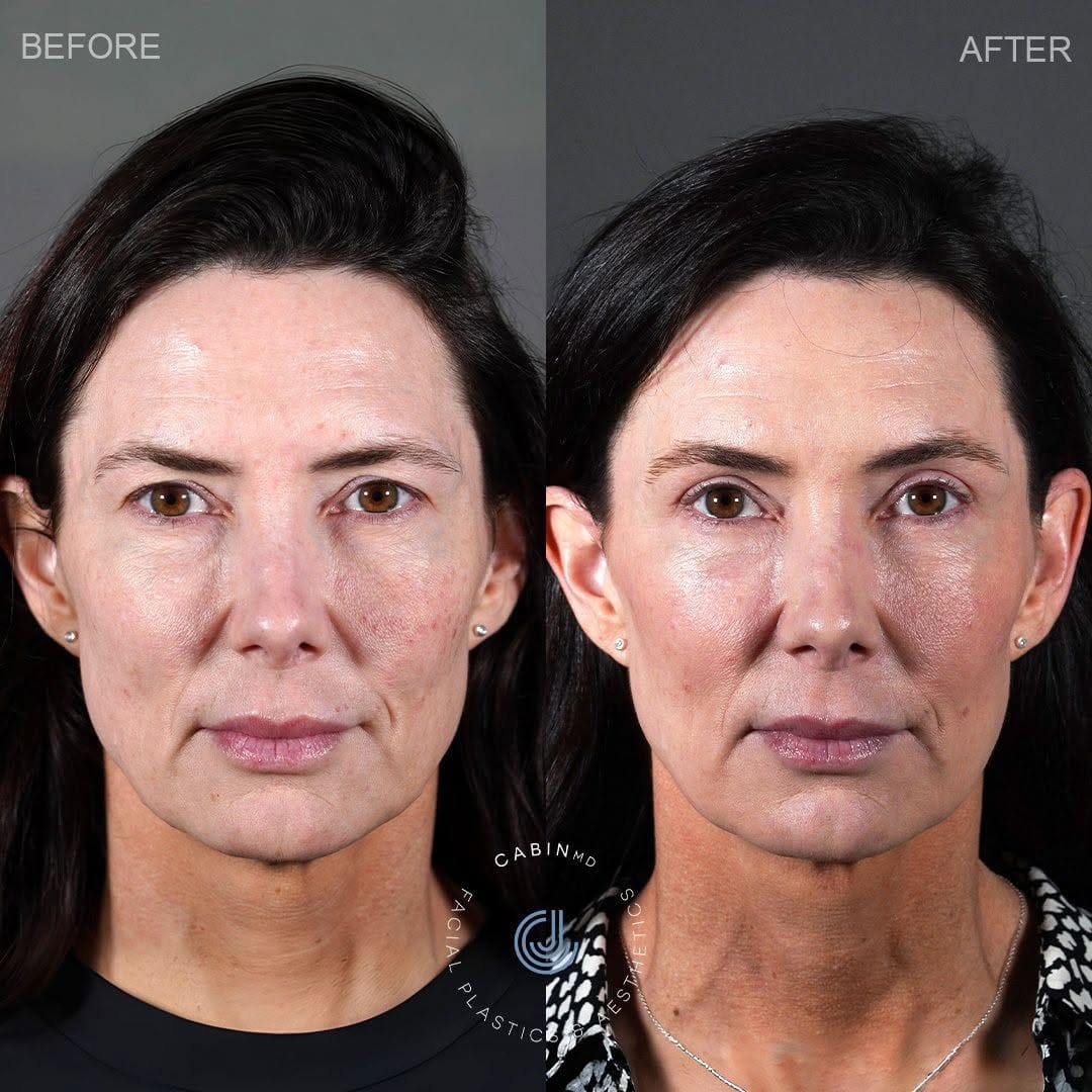 Post 5 by Jon Cabin - DC Plastic Surgeon on Instagram (carousel)