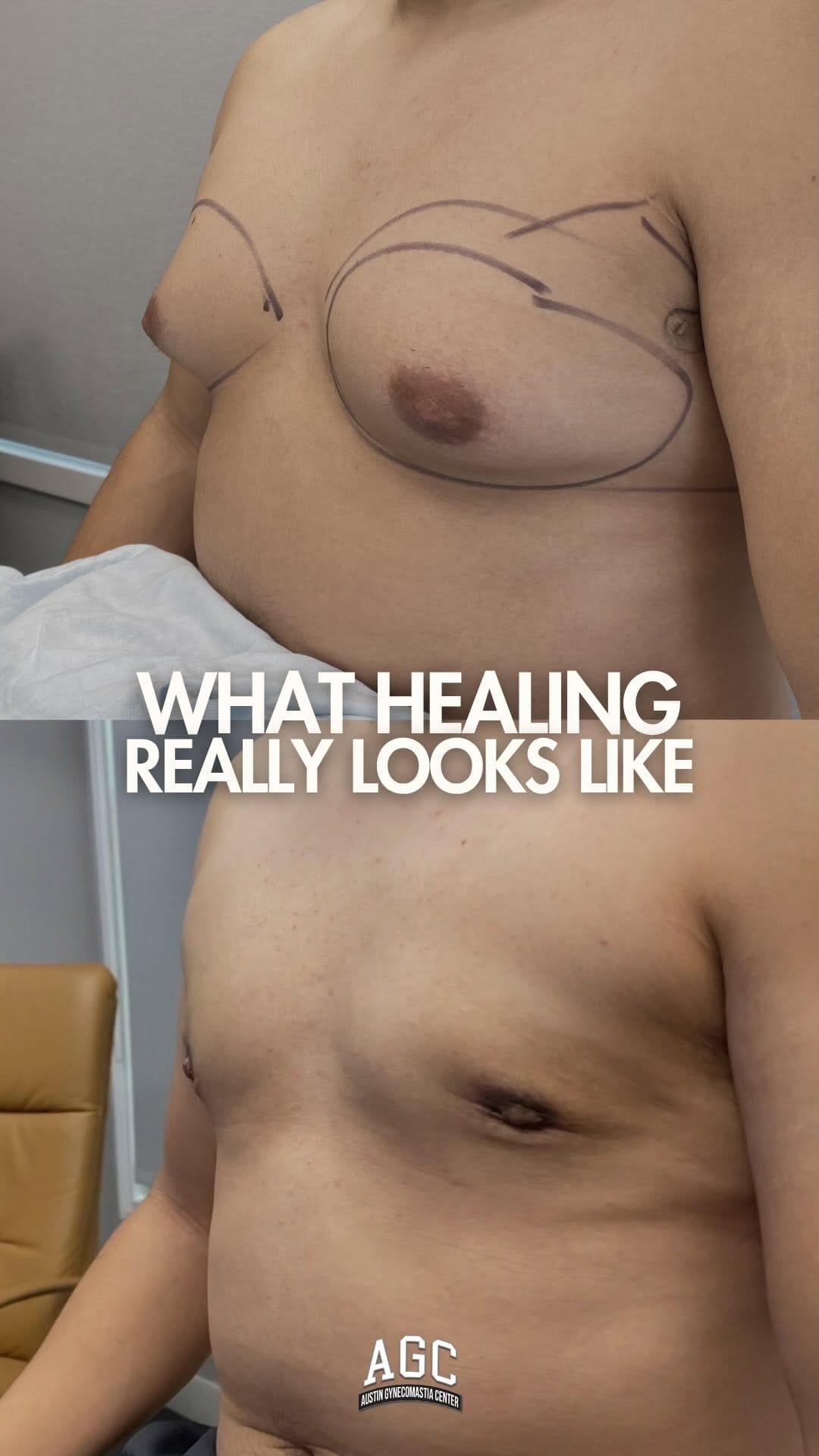 Post 2 by Robert Caridi, MD || Austin Gynecomastia Center on Instagram (video)