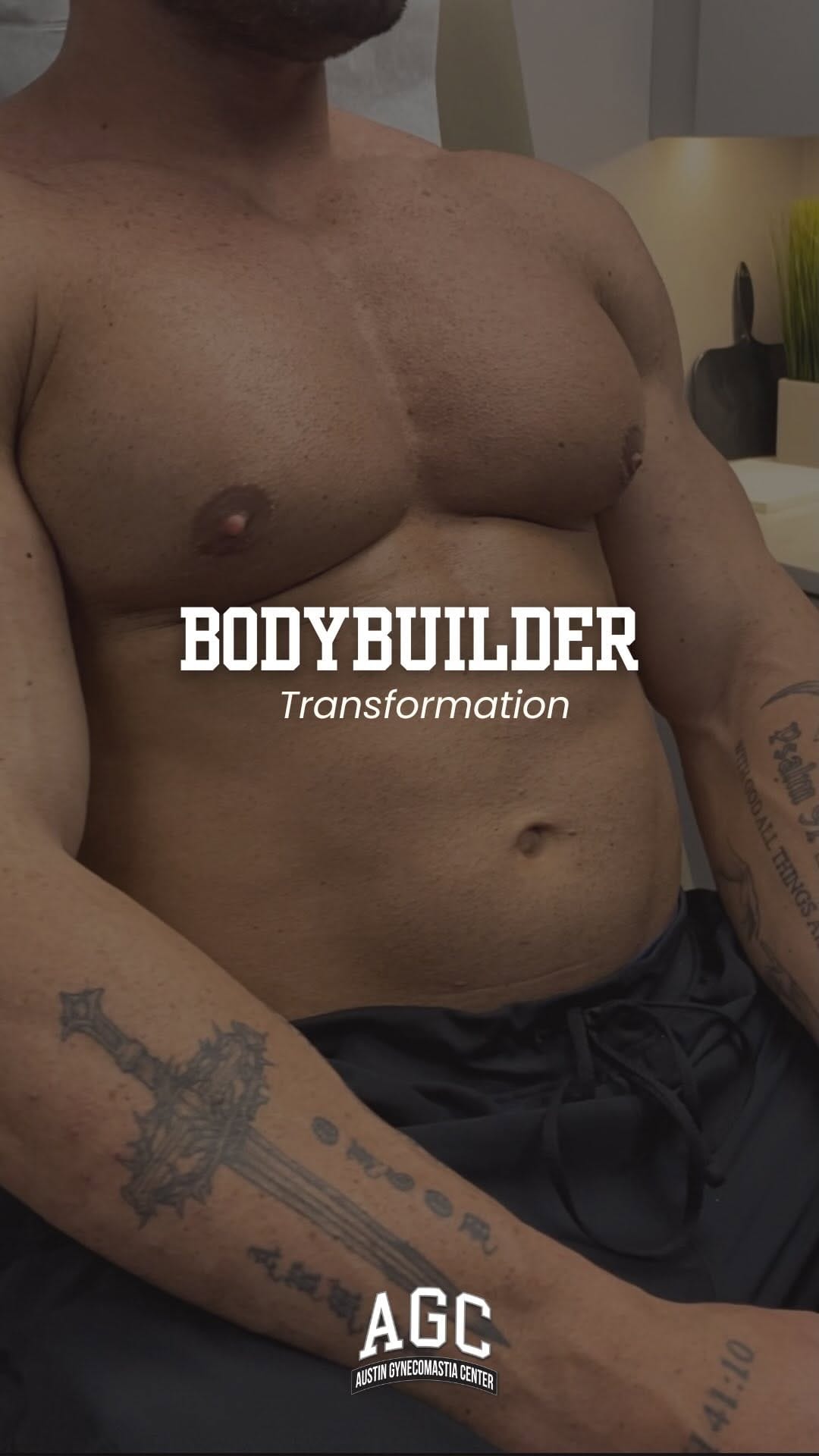 Post 4 by Robert Caridi, MD || Austin Gynecomastia Center on Instagram (video)