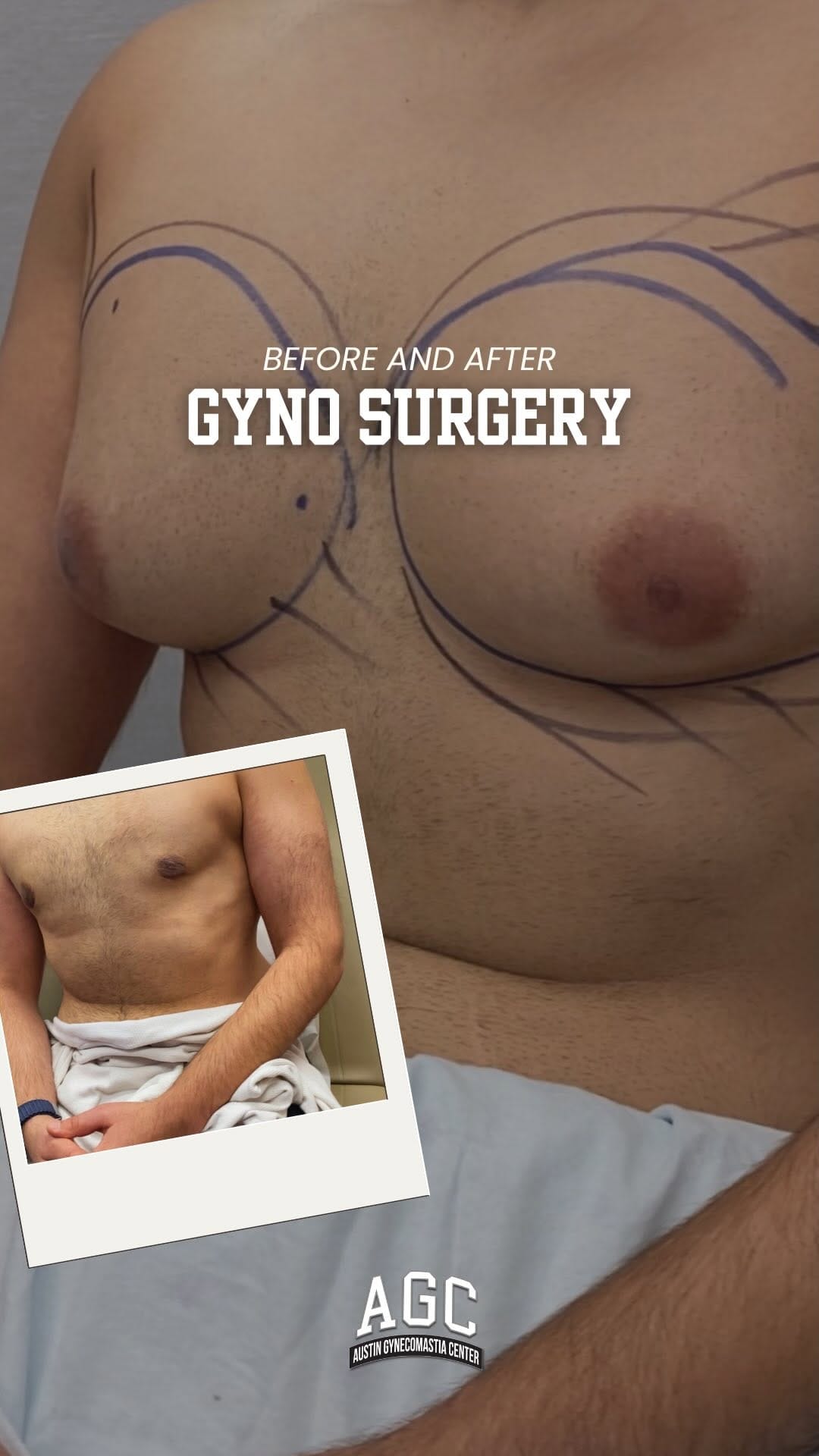 Post 7 by Robert Caridi, MD || Austin Gynecomastia Center on Instagram (video)