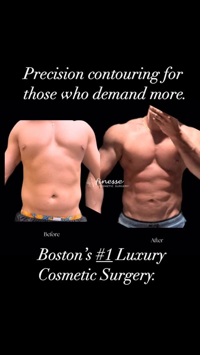 Post 8 by Finesse Cosmetic Surgery on Instagram (video)
