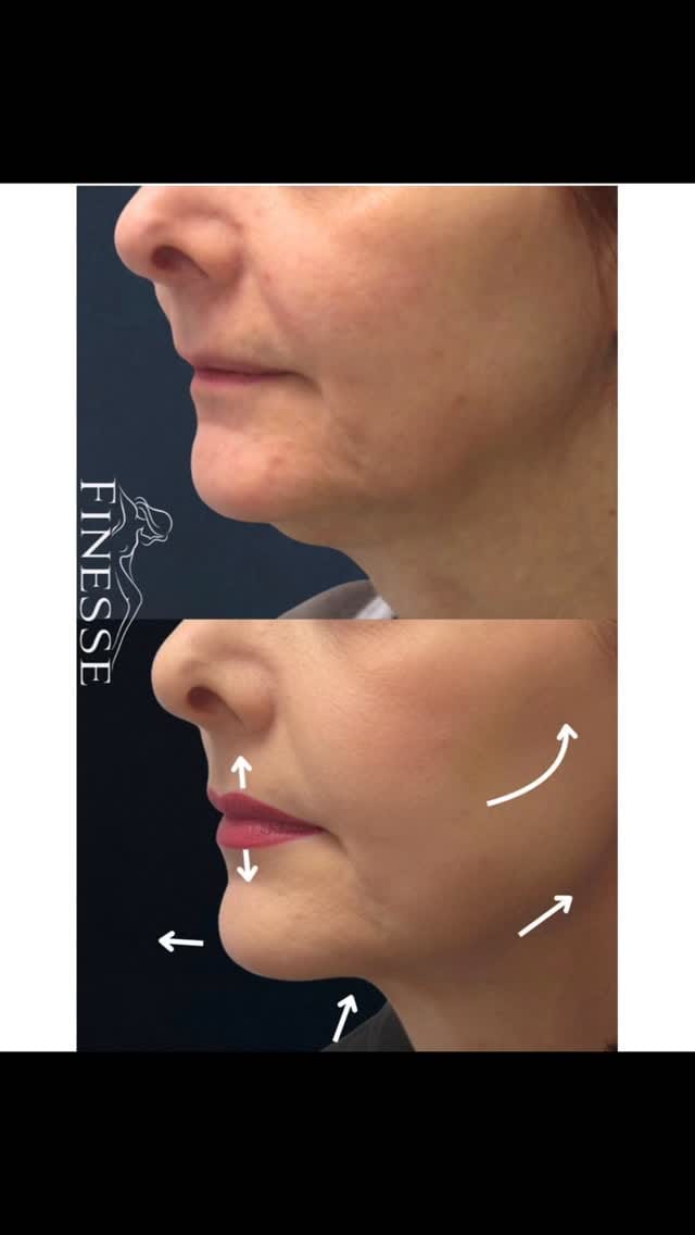 Post 2 by Finesse Cosmetic Surgery on Instagram (video)