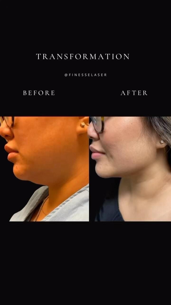 Post 10 by Finesse Cosmetic Surgery on Instagram (video)