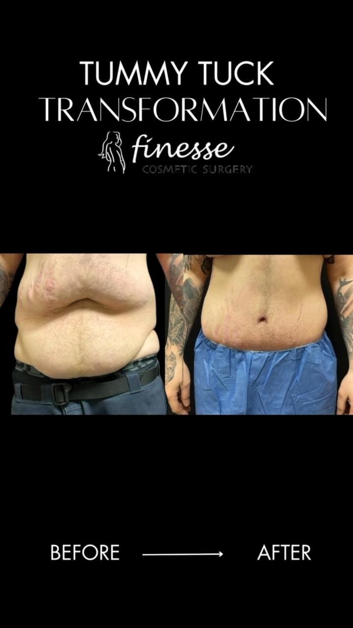 Post 9 by Finesse Cosmetic Surgery on Instagram (video)