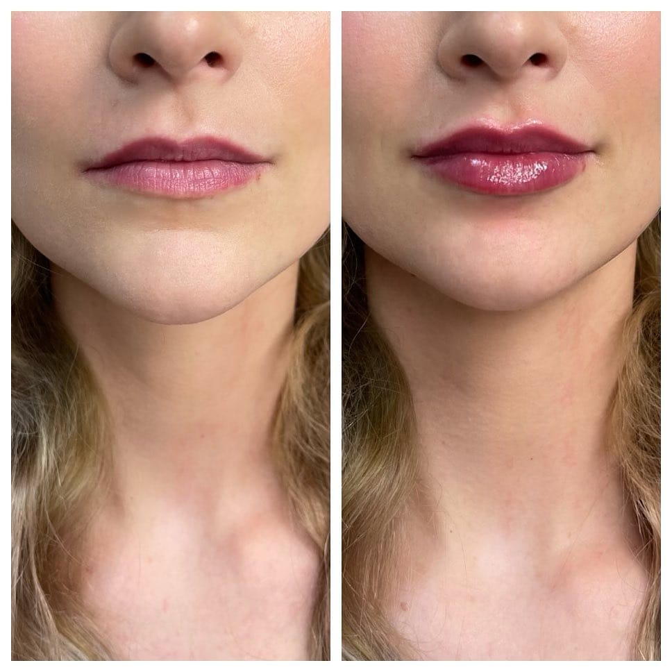 Post 8 by Grace Medical Aesthetics 💉 CT + NY MedSpa on Instagram (image)