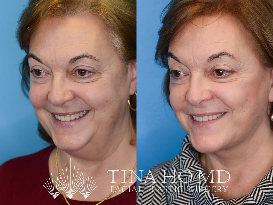 Post 6 by Facial Plastic Surgery | Cosmetics | Philly & Main Line on Instagram (carousel)