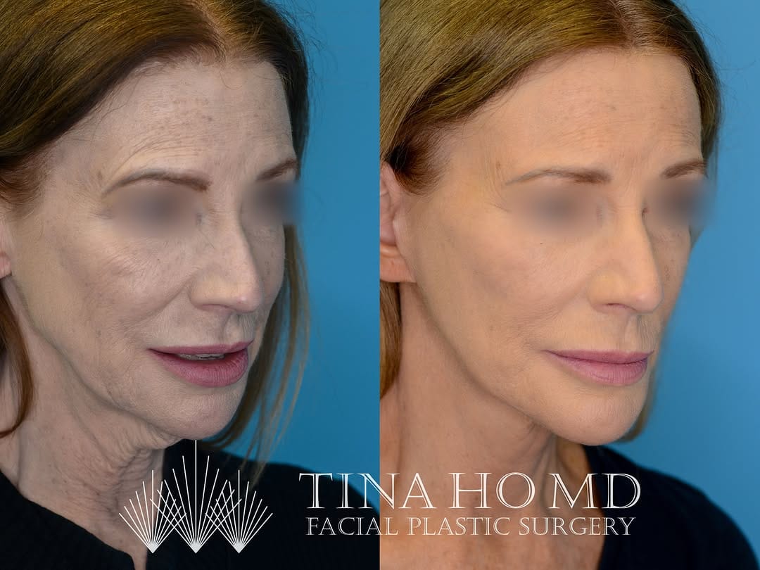 Post 4 by Facial Plastic Surgery | Cosmetics | Philly & Main Line on Instagram (carousel)