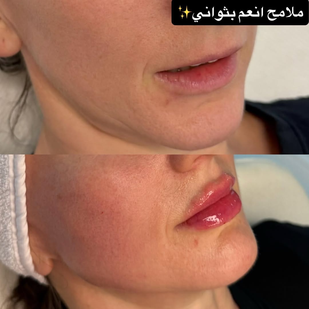 Post 2 by Dr.Rand Alhayali 💉🇮🇶🇨🇦💉 on Instagram (carousel)