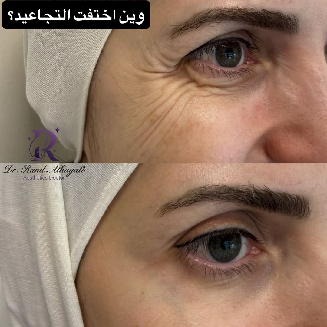 Post 5 by Dr.Rand Alhayali 💉🇮🇶🇨🇦💉 on Instagram (carousel)