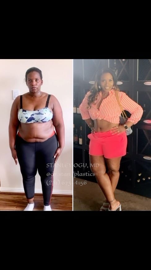Post 4 by Stanley Ogu, MD FACS on Instagram (video)