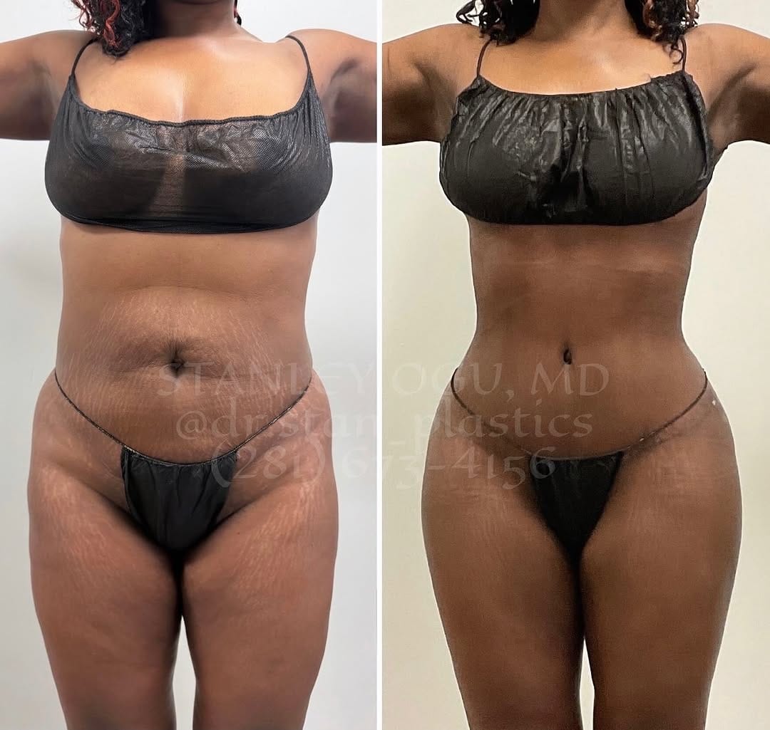 Post 2 by Stanley Ogu, MD FACS on Instagram (image)