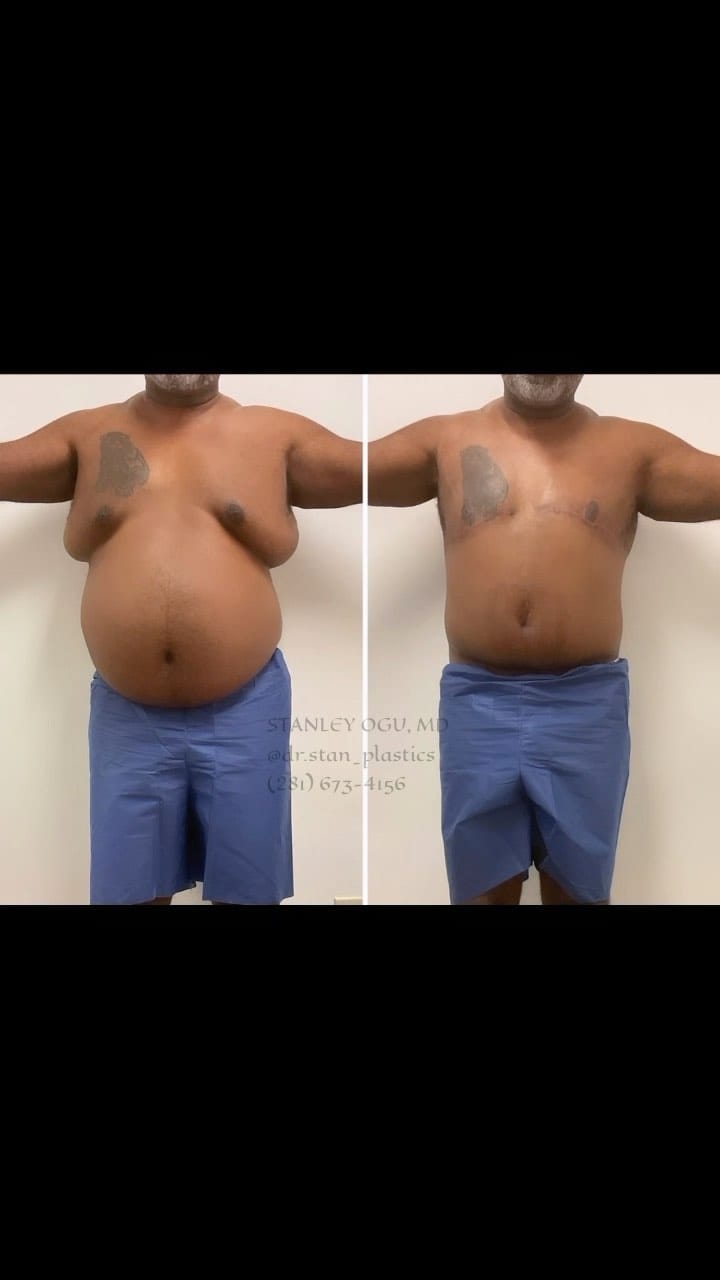 Post 5 by Stanley Ogu, MD FACS on Instagram (video)