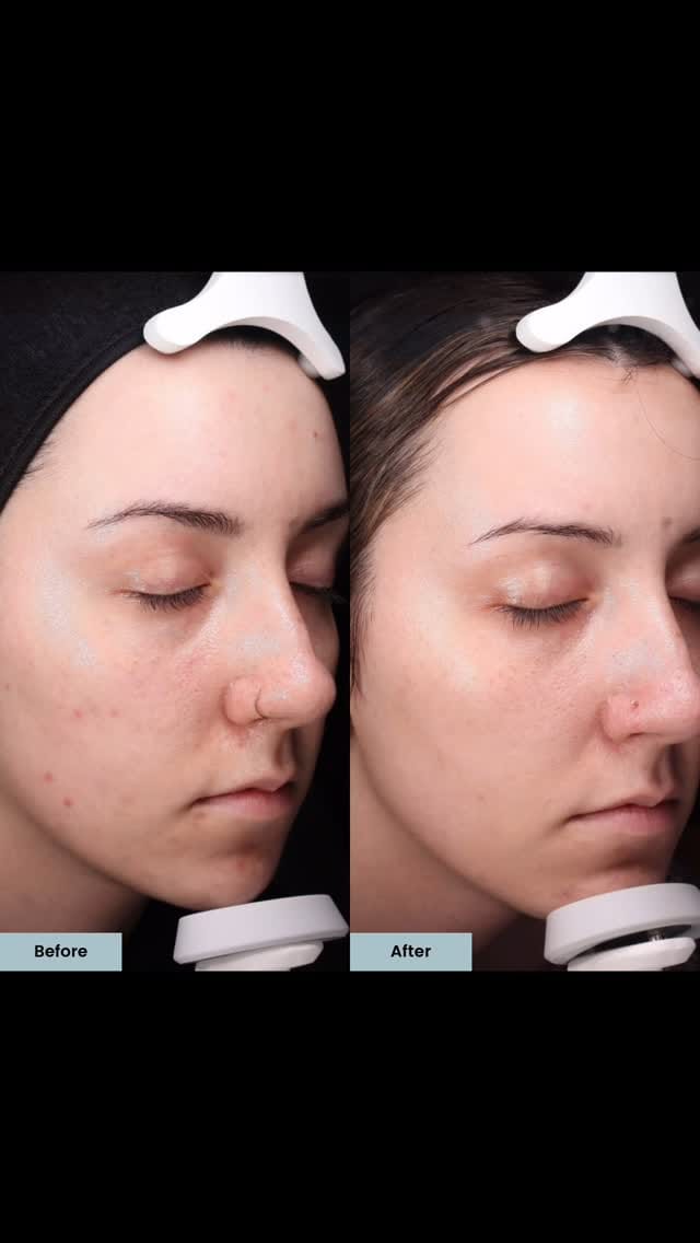 Post 4 by ELLEMES Medical Spa | Atlanta on Instagram (video)
