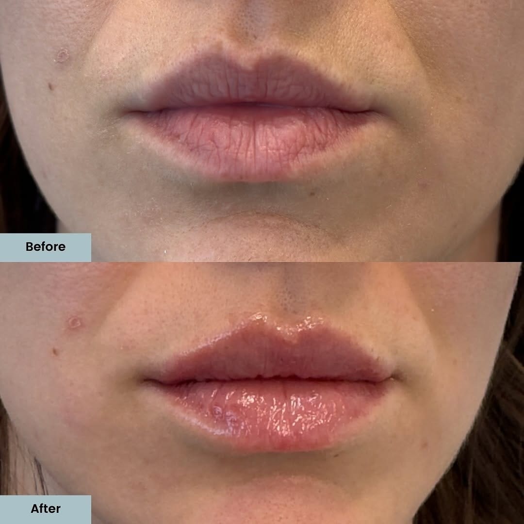 Post 2 by ELLEMES Medical Spa | Atlanta on Instagram (carousel)