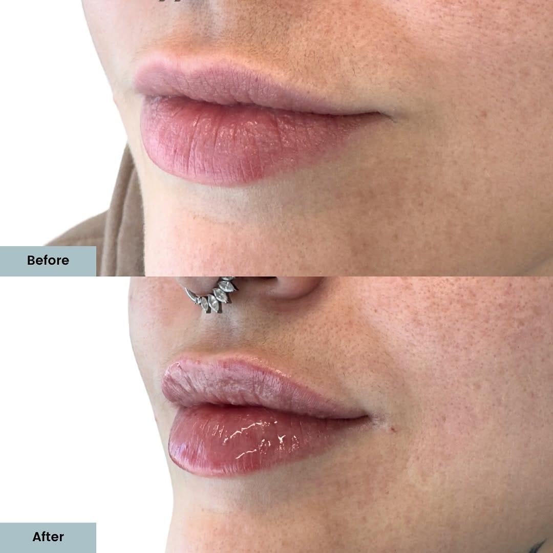 Post 6 by ELLEMES Medical Spa | Atlanta on Instagram (image)