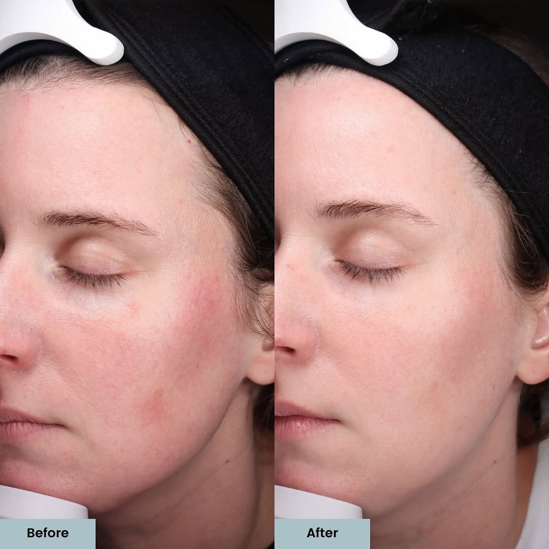 Post 9 by ELLEMES Medical Spa | Atlanta on Instagram (carousel)