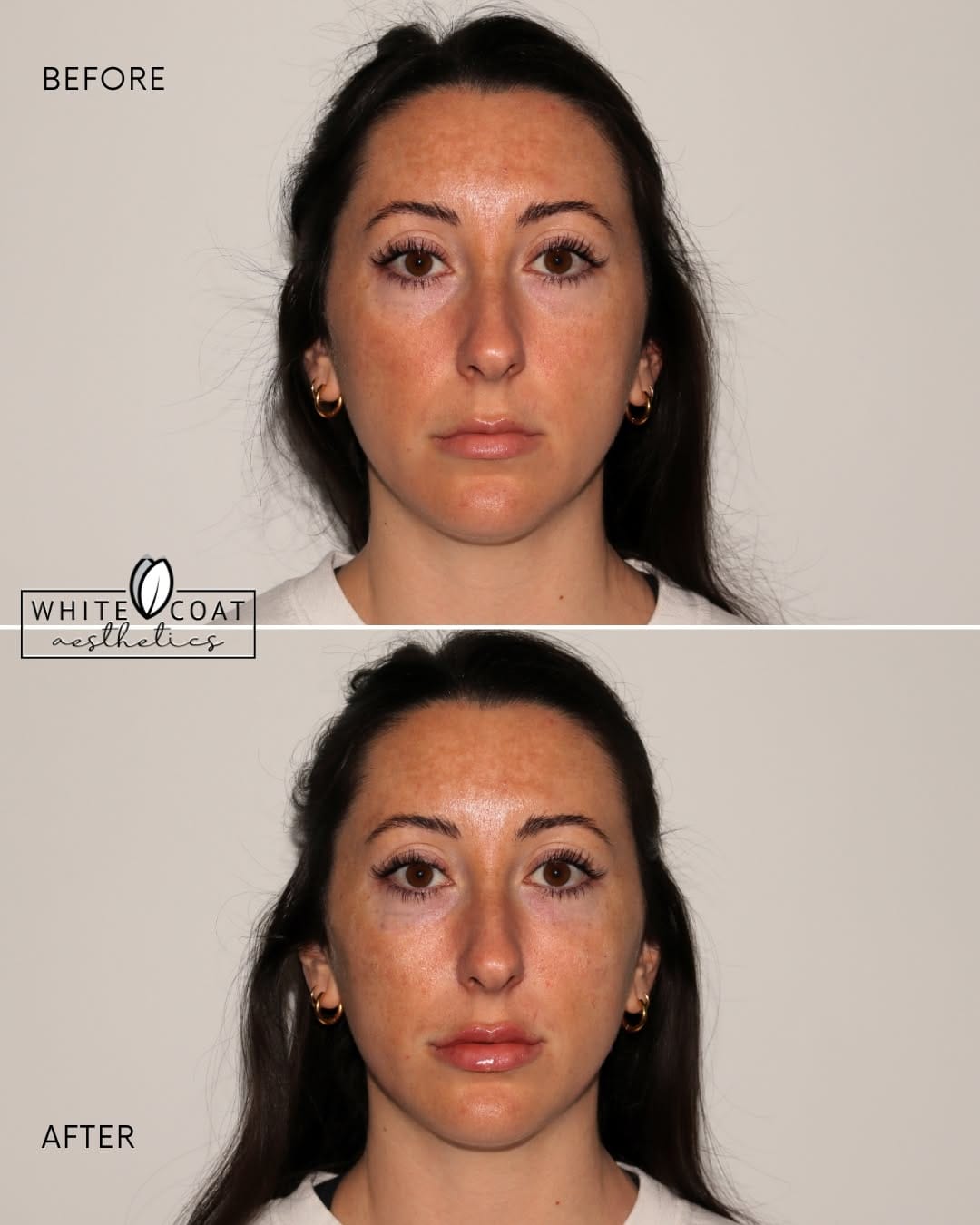 Post 4 by Las Vegas Botox, Fillers, Sculptra, Skincare on Instagram (carousel)
