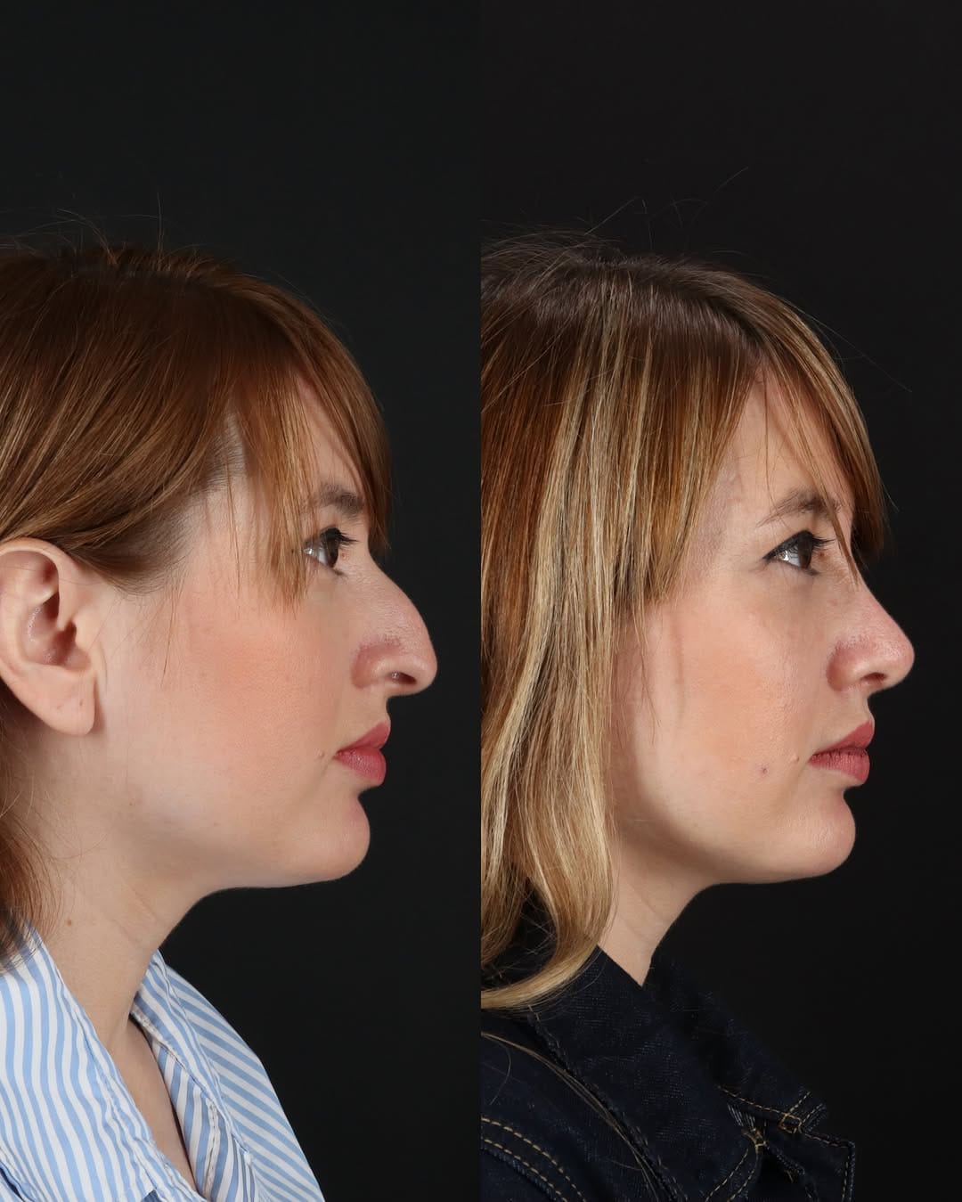 Post 1 by Dr. Sanaz Harirchian | Facial Plastic Surgeon on Instagram (carousel)