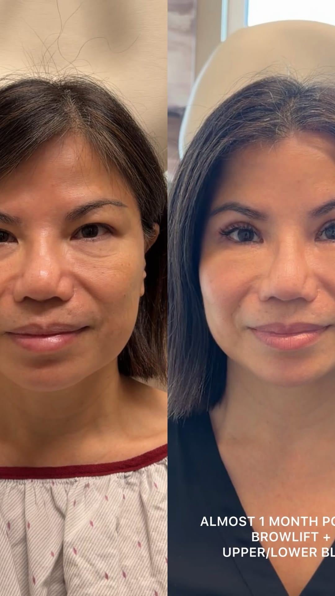 Post 7 by Dr. Sanaz Harirchian | Facial Plastic Surgeon on Instagram (video)
