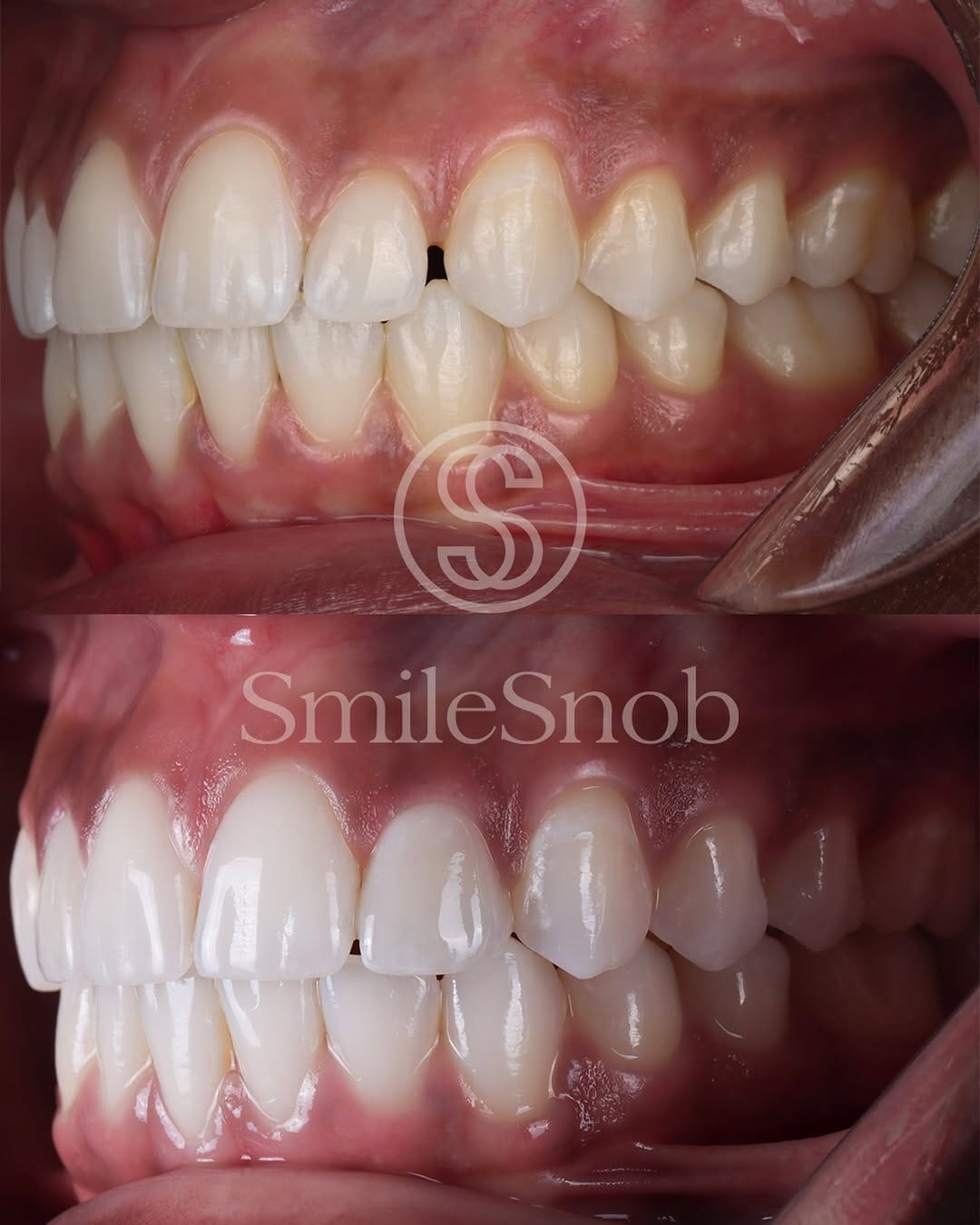 Post 5 by Veneers & Dental Implants in New Orleans on Instagram (image)