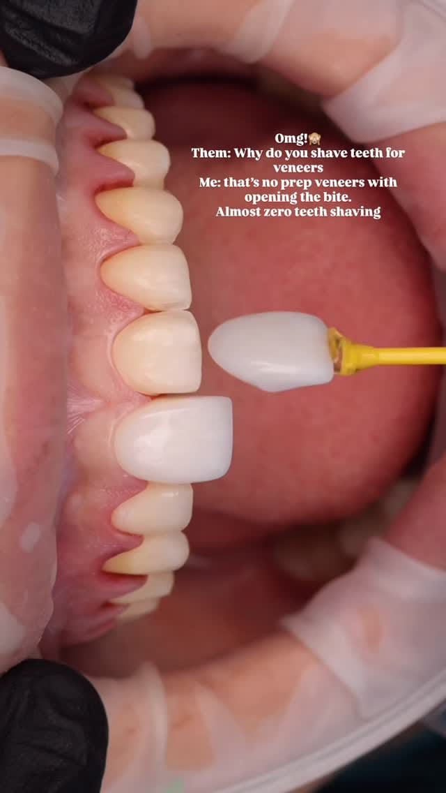Post 9 by Mina Antoun Cosmetic Dentist, Veneers & Implants on Instagram (video)