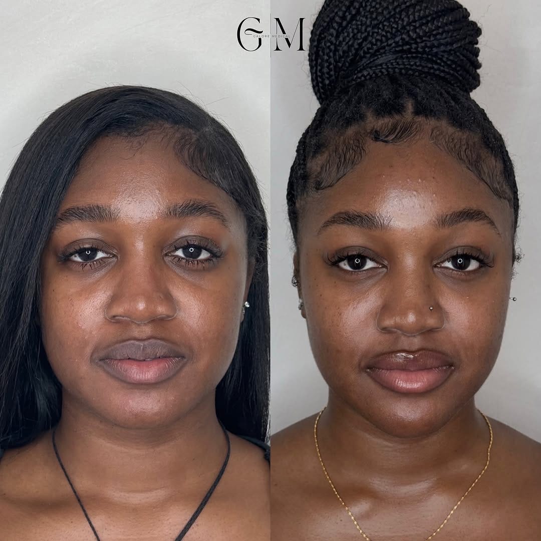 Post 10 by Galore Medical - Botox, Fillers, PDO Threads on Instagram (carousel)
