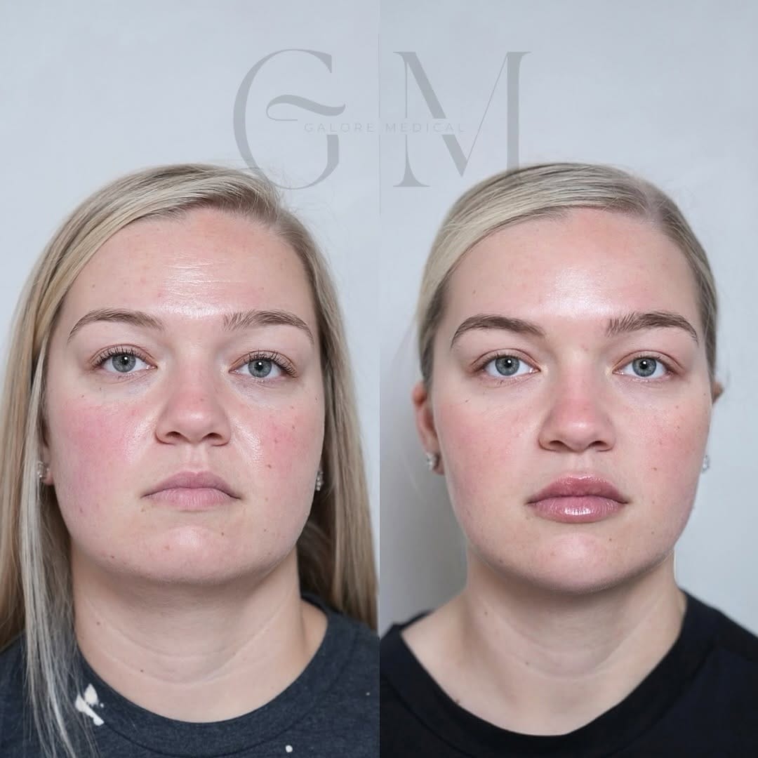 Post 3 by Galore Medical - Botox, Fillers, PDO Threads on Instagram (carousel)