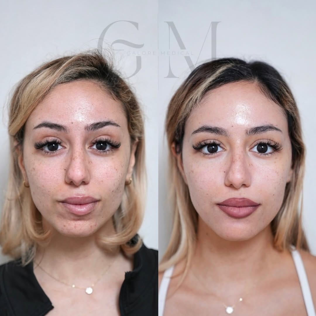 Post 4 by Galore Medical - Botox, Fillers, PDO Threads on Instagram (carousel)