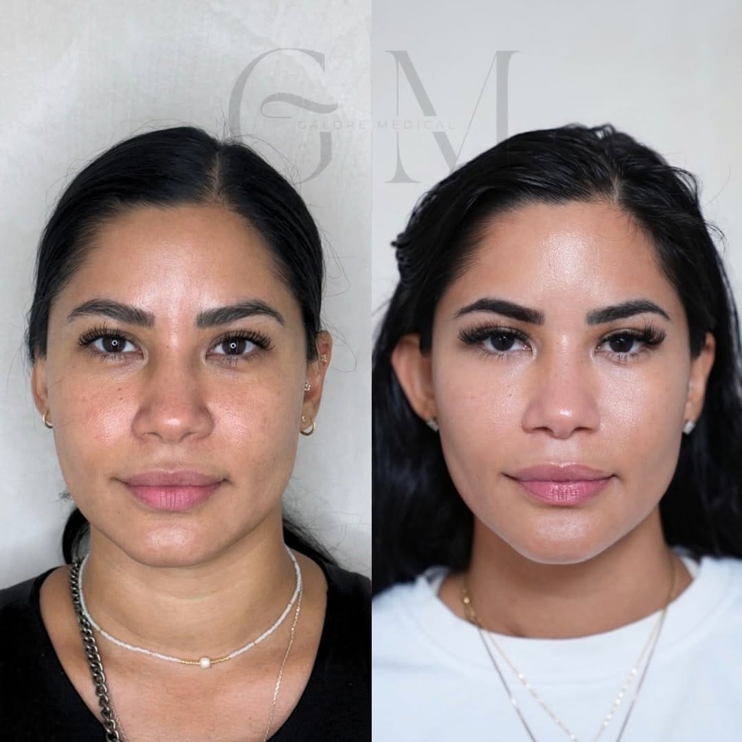 Post 6 by Galore Medical - Botox, Fillers, PDO Threads on Instagram (carousel)