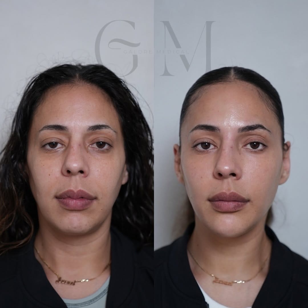 Post 8 by Galore Medical - Botox, Fillers, PDO Threads on Instagram (carousel)