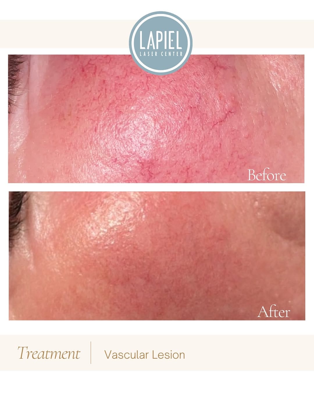 Post 10 by Lapiel Laser Center on Instagram (image)