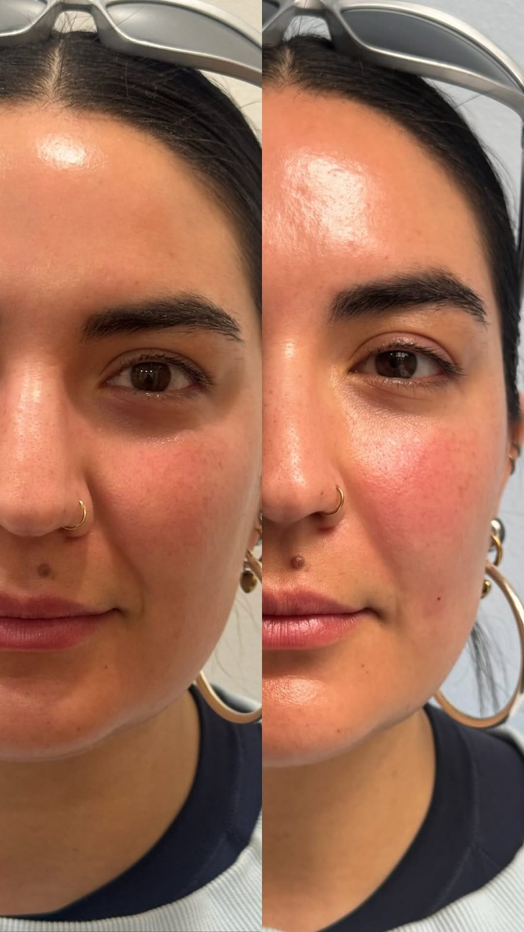 Post 8 by Lapiel Laser Center on Instagram (video)