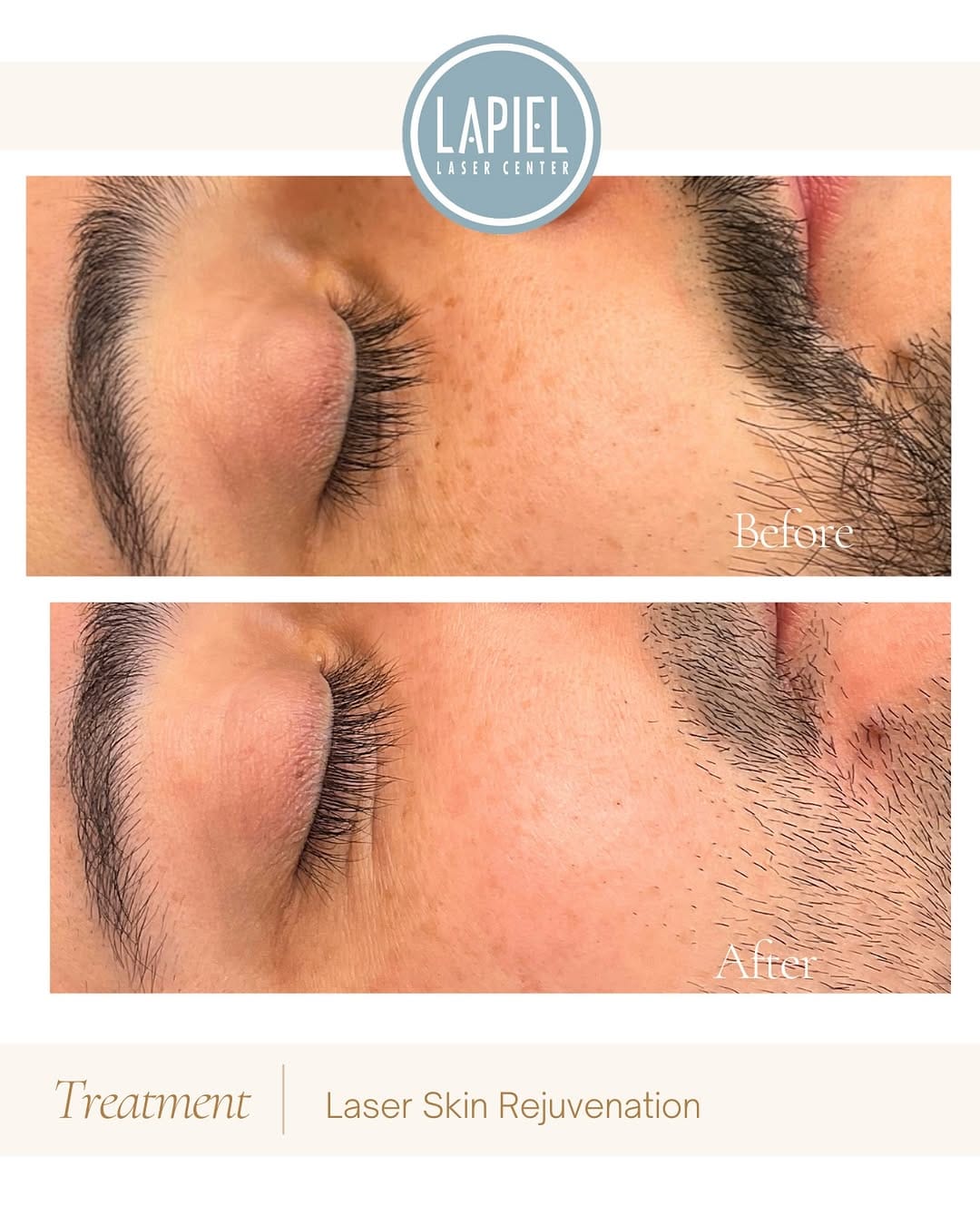 Post 4 by Lapiel Laser Center on Instagram (image)