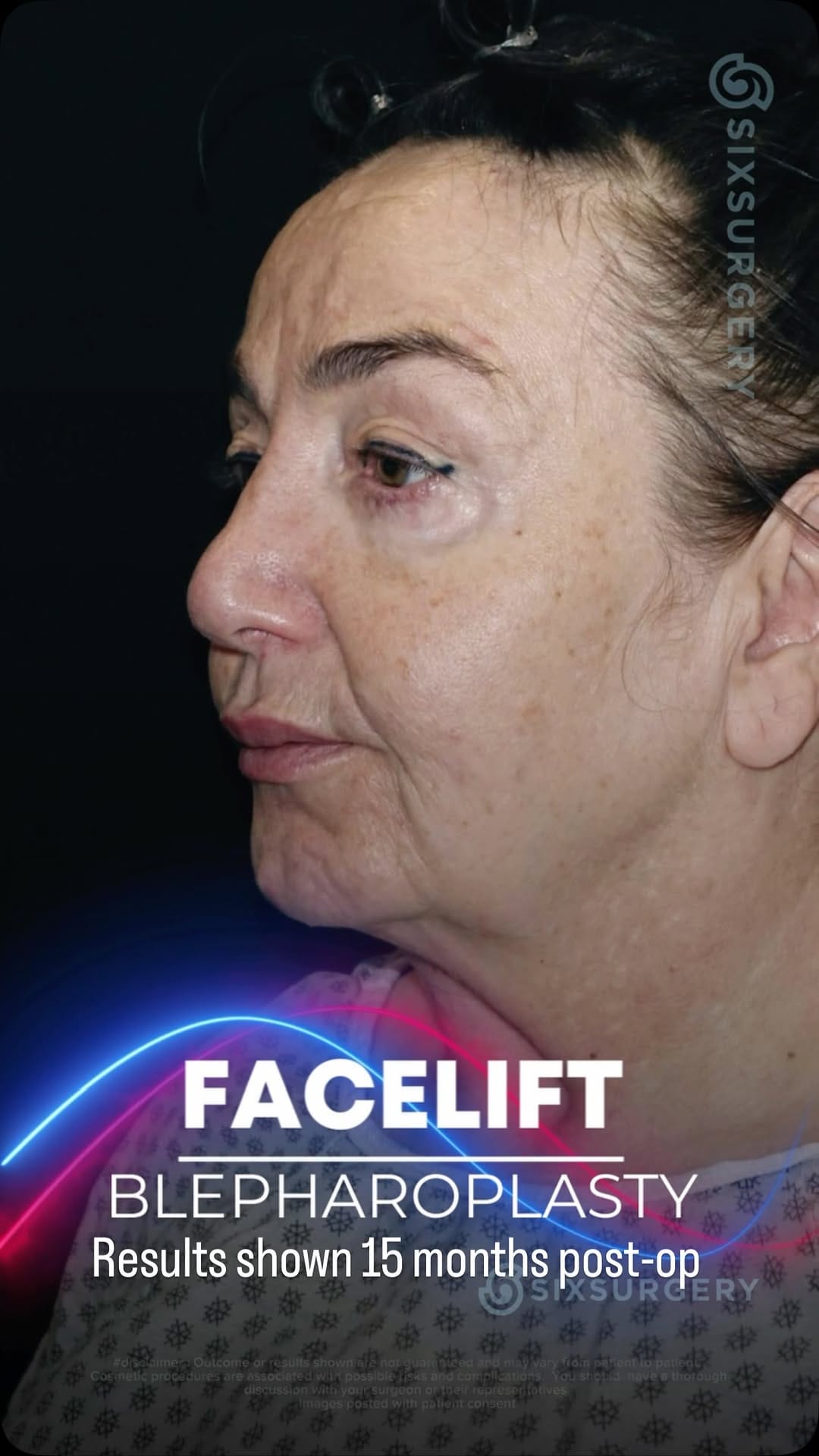 Post 6 by Dr Martin Jugenburg (Dr6ix) - Plastic Surgeon on Instagram (video)