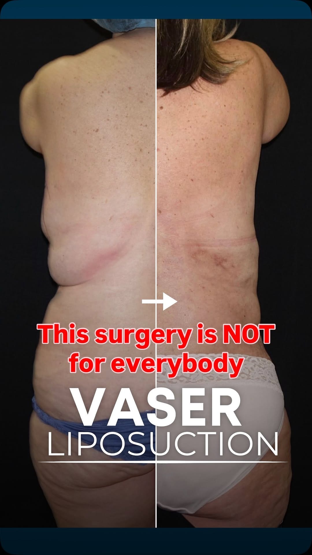Post 8 by Dr Martin Jugenburg (Dr6ix) - Plastic Surgeon on Instagram (video)