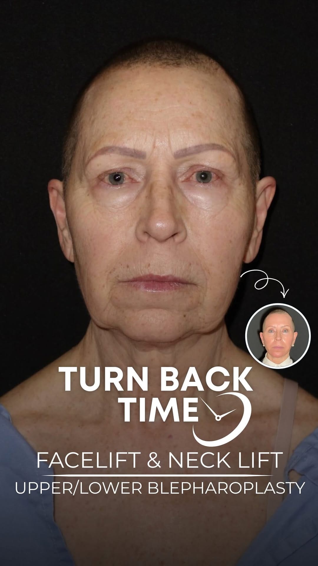 Post 3 by Dr Martin Jugenburg (Dr6ix) - Plastic Surgeon on Instagram (video)
