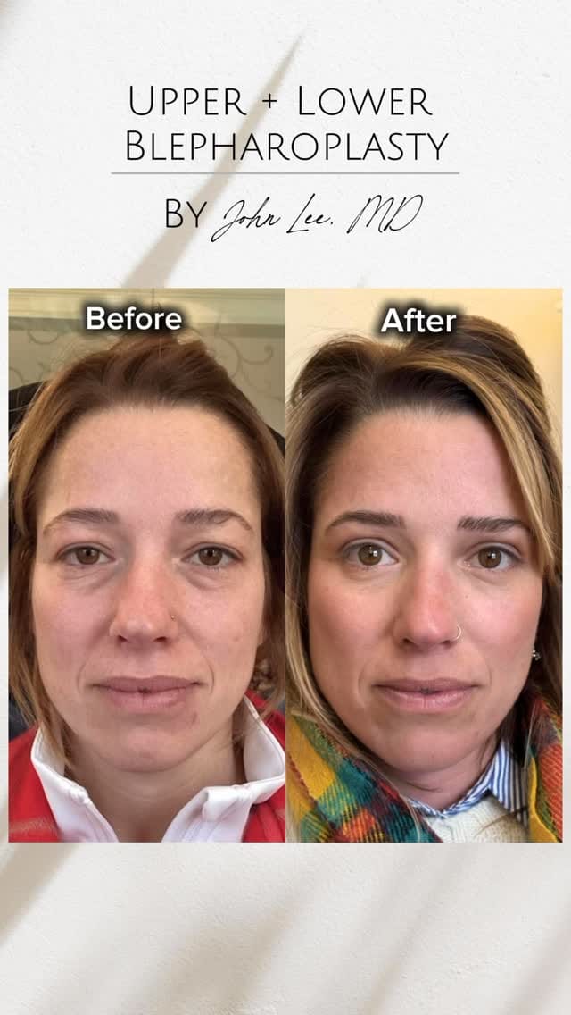 Post 4 by EYELIDS SURGERY • BOTOX • MEDSPA on Instagram (video)