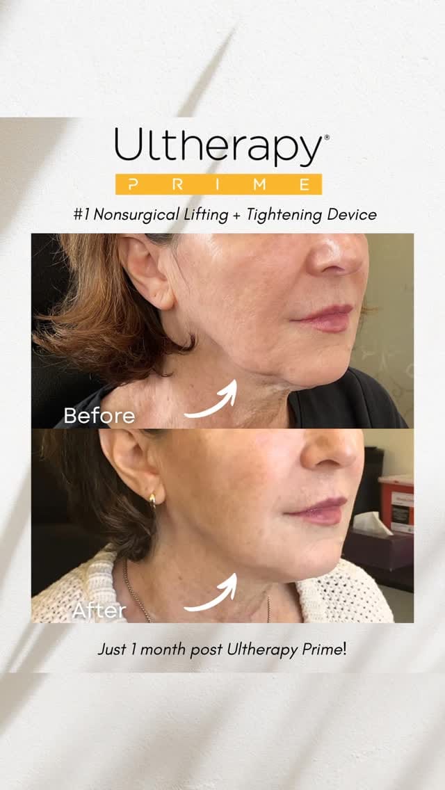 Post 3 by EYELIDS SURGERY • BOTOX • MEDSPA on Instagram (video)