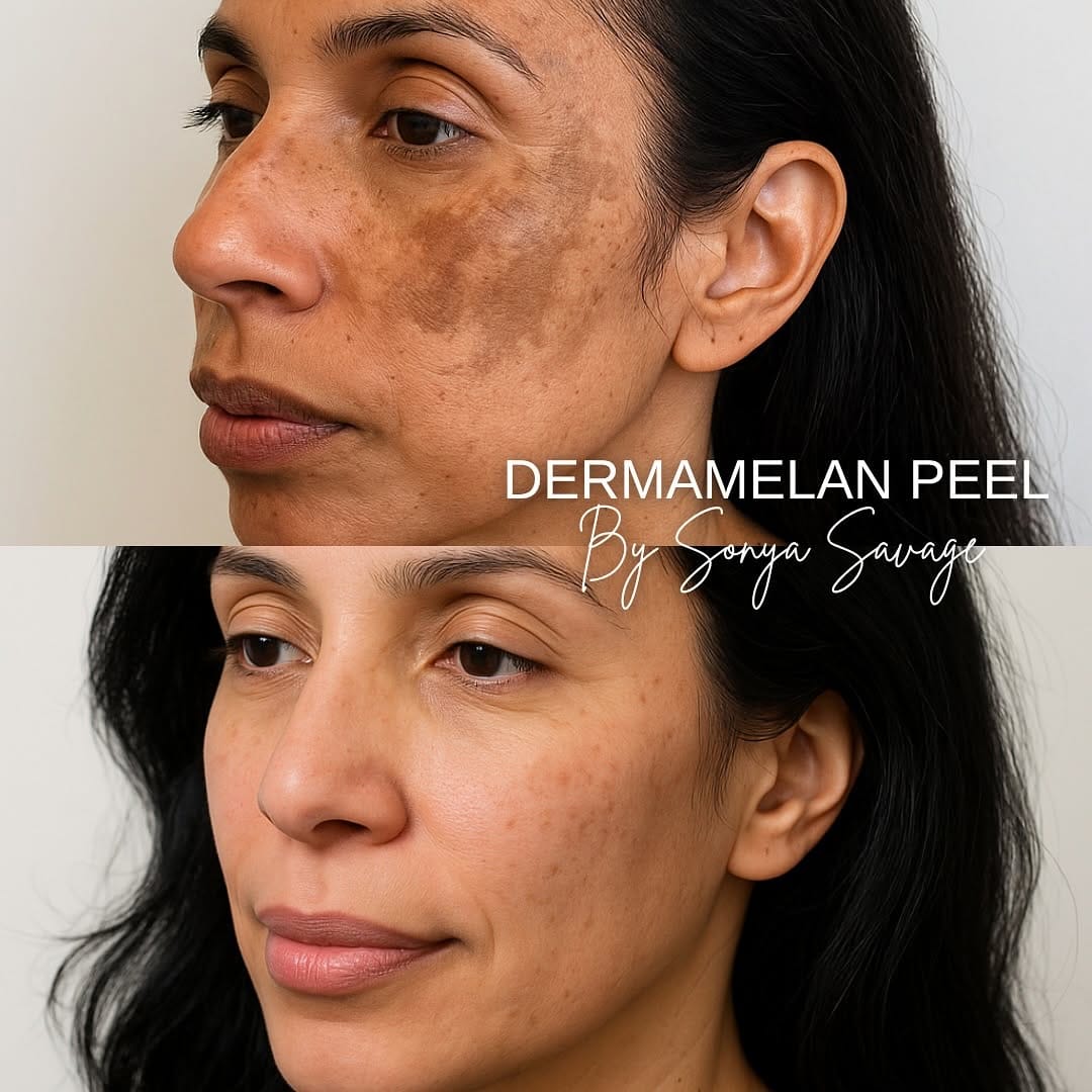 Post 10 by EYELIDS SURGERY • BOTOX • MEDSPA on Instagram (image)