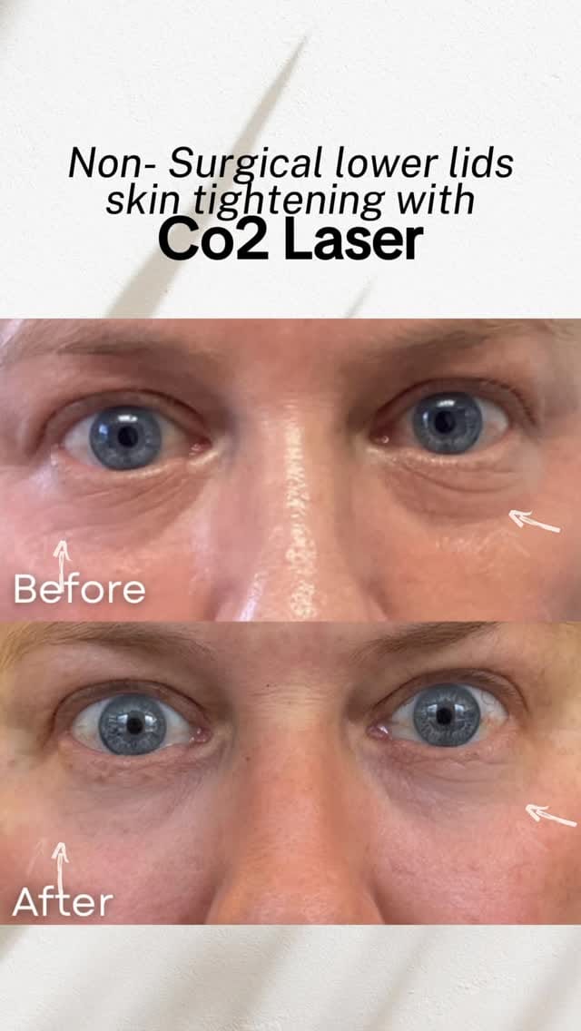 Post 5 by EYELIDS SURGERY • BOTOX • MEDSPA on Instagram (video)