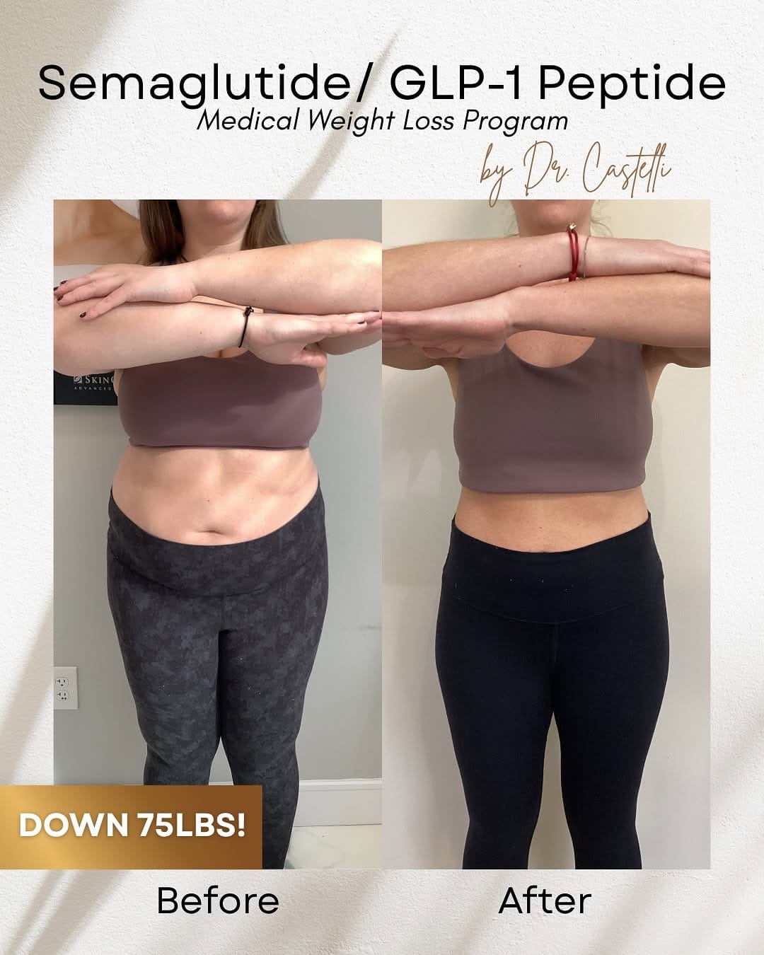 Post 8 by EYELIDS SURGERY • BOTOX • MEDSPA on Instagram (carousel)